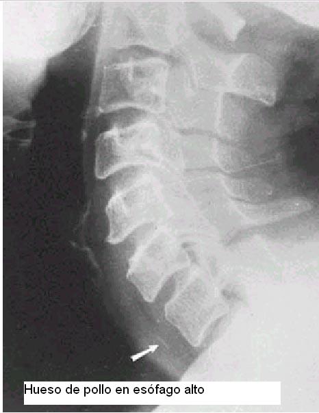 Hueso en tercio superior de esófago