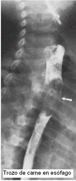 Trozo de carne en tercio superior de esófago
